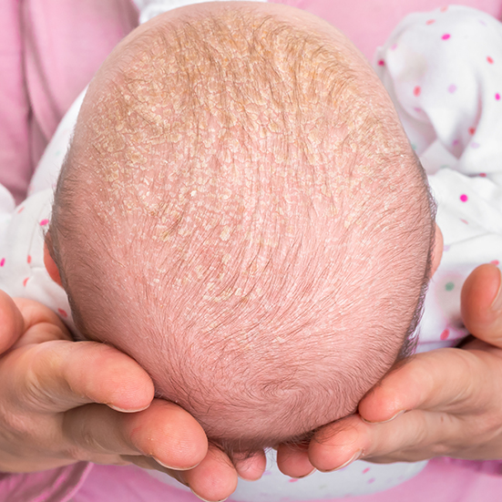 Les croûtes de lait : symptômes, causes et traitement